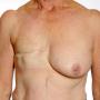 Right mastectomy - front view