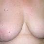 Twelve months following surgery to remove left breast and undertake TRAM flap breast reconstruction.