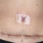 Six months following surgery to remove the right breast and undertake TRAM flap breast reconstruction- scars across lower abdomen and around the umbilicus (belly button) from where the TRAM flap was taken. The raised and redenned scars are called keloid scarring. A clear dressing product has been placed along the scars to treat the keloid scarring.