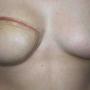 Twelve months following surgery to remove the right breast and undertake TRAM flap breast reconstruction. A clear dressing product has been placed along the scars to treat the keloid scarring.