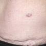 Twelve months following surgery to remove both breasts and undertake TRAM flap breast reconstruction- scars across lower abdomen and around the umbilicus (belly button) from where the TRAM flap was taken.