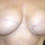 Twelve months following surgery to remove both breasts and undertake TRAM flap breast reconstruction.