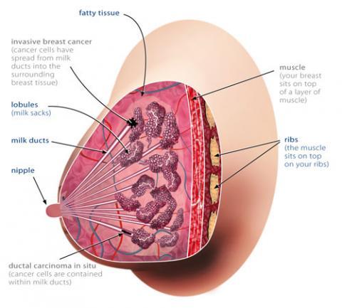 Illustration of a woman's breast, showing DCIS and invasive breast cancer