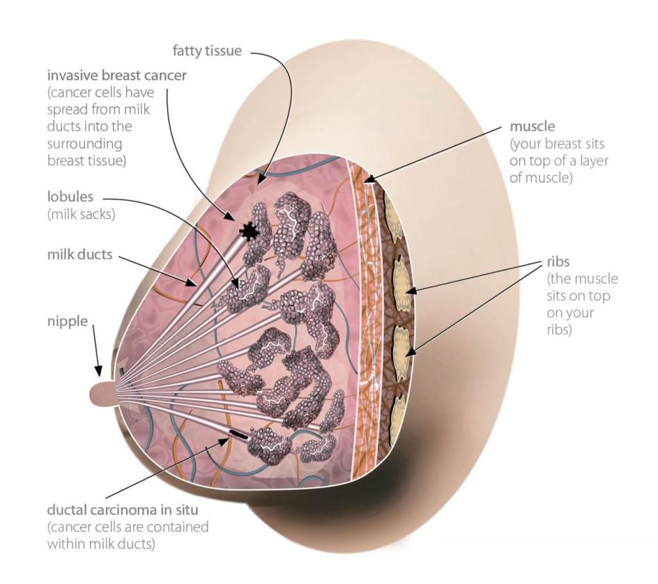 Figure 1: Illustration of a woman’s breast showing ductal carcinoma in situ and invasive breast cancer 