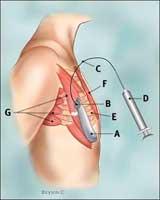  Side view of breast area with unfilled tissue expander in place.