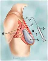  Side view of breast area with filled tissue expander in place labels.