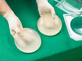 Breast reconstruction using implants