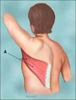 Woman with latissimus dorsi muscle in place.