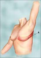 Woman with latissimus dorsi muscle swung forward to re–create the new breast.