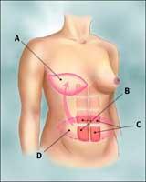 Woman after mastectomy: showing TRAM and surrounding tissues in preparation for breast reconstruction.